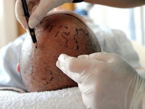 Подробнее о статье Мужчина умер после пересадки волос и лечения зубов